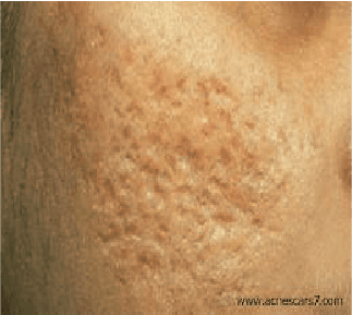 Acne Scars