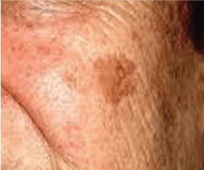Age Spot