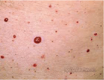 Cherry Angioma