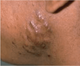 Clogged Pores