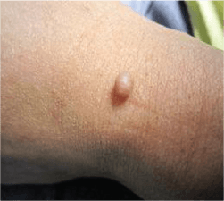 Fibroma