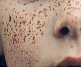 Freckles