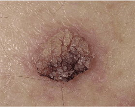 Keratosis