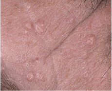 Sebaceous Hyperplasia
