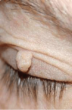 Skin Tag on Eyelid
