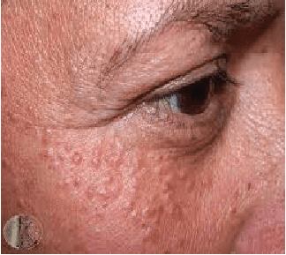 Syringoma