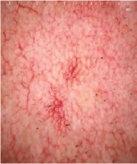Telangiectasis