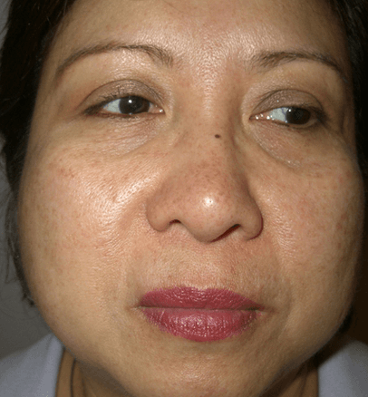 After — case 5