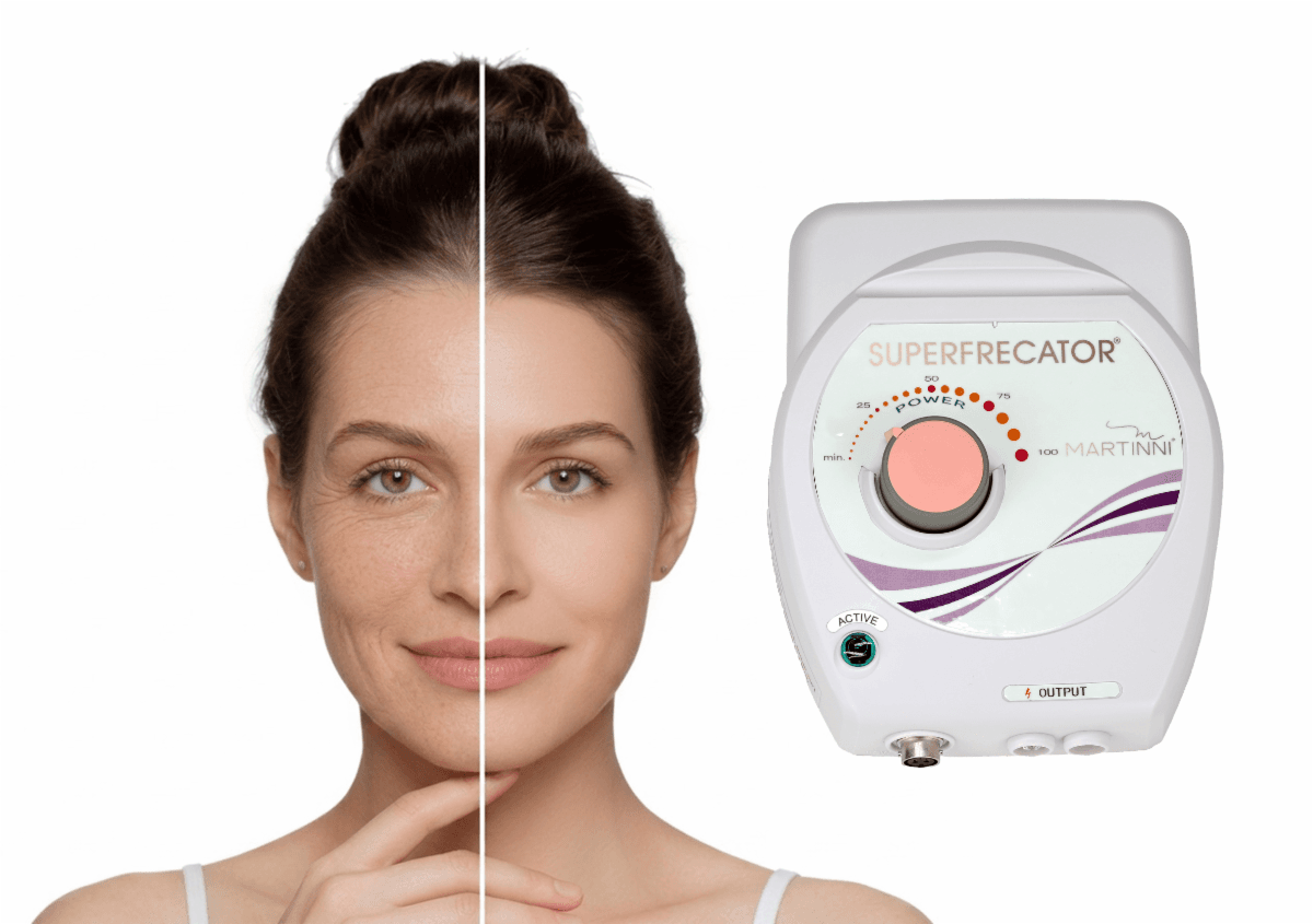 SuperFrecator Gen 3 skin-tightening before and after with device